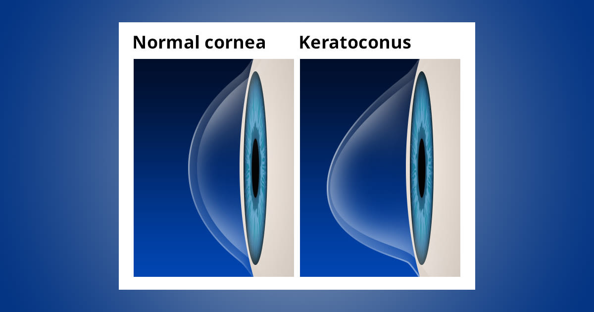 Keratoconus Causes & Symptoms