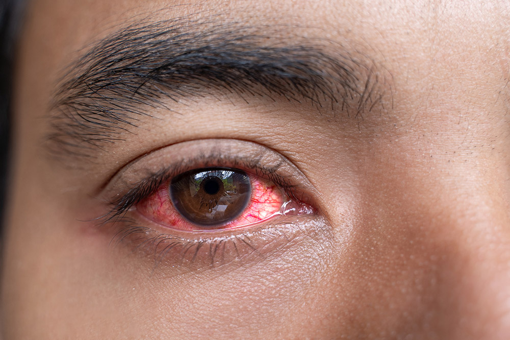 Types of Red Eye