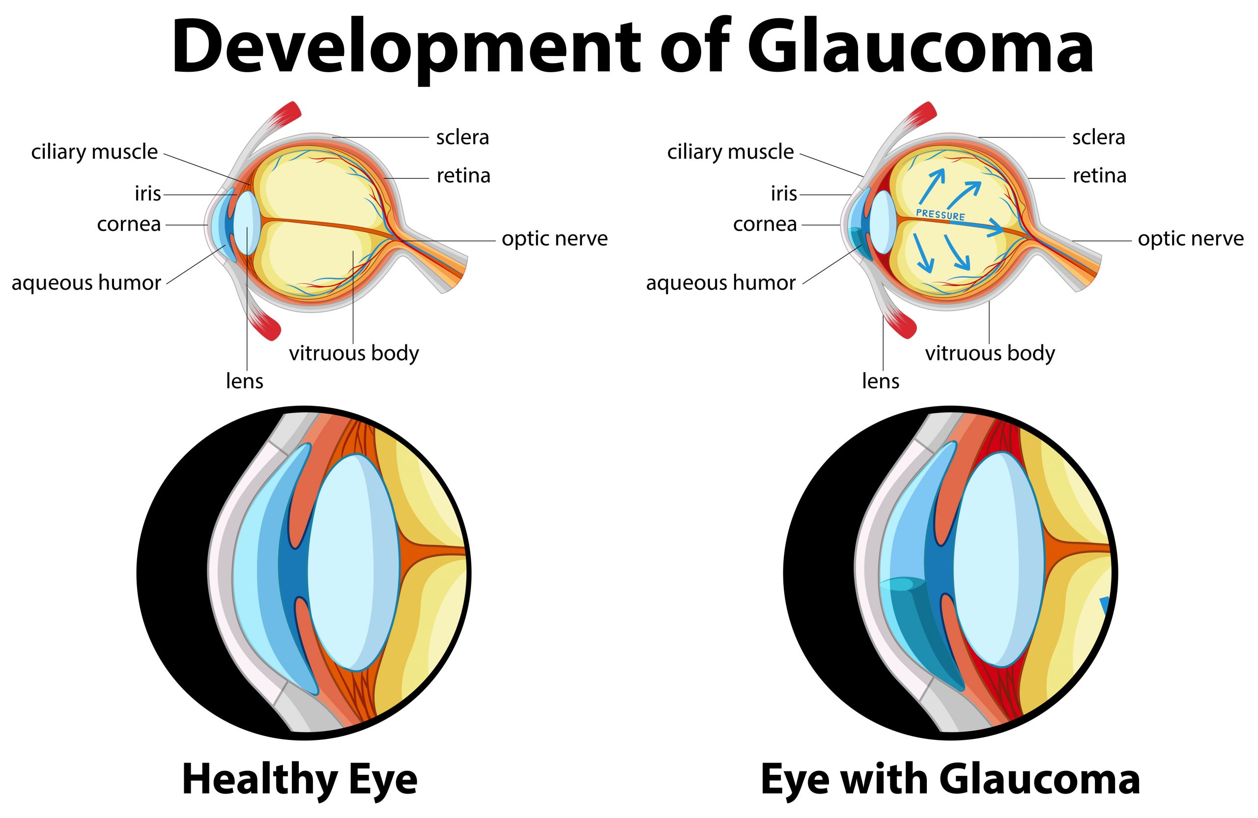 Are you at risk of Glaucoma?