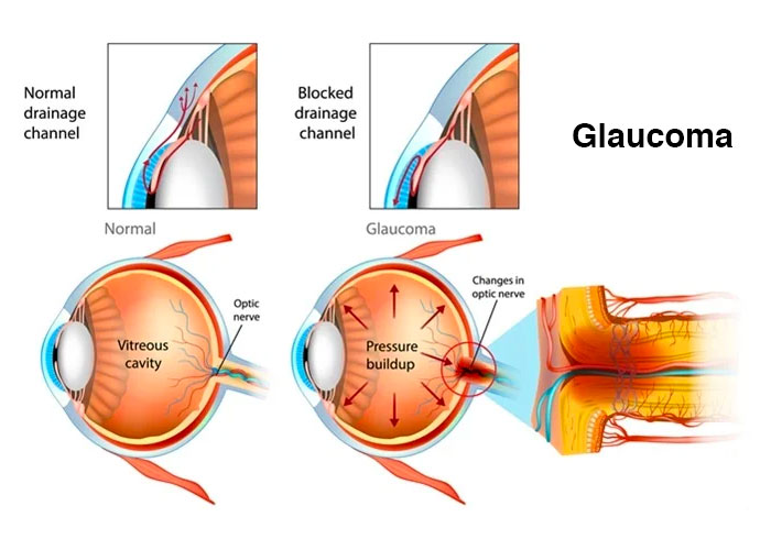 Glaucoma - The Silent Thief of Sight