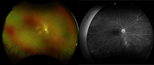 Widefield_colour_and_fluorescein_angiography_images_of_the_retina