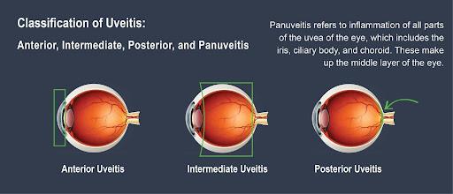 Diagram_showing_anterior,_intermediate,_and_posterior_uveitis 
